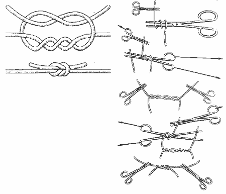 Хирургический узел Хирургический узел
